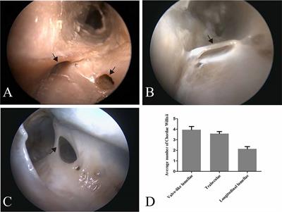 Related Structures in the Straight Sinus: An Endoscopic Anatomy and Histological Study